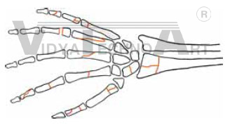 Fracture Chart of series